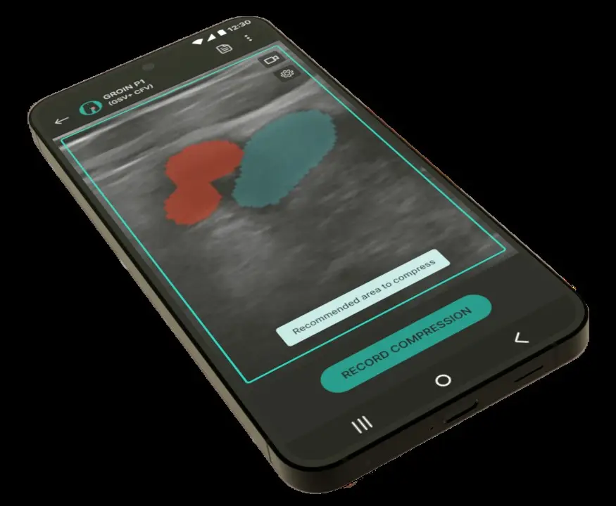 Smartphone screen displaying the ThinkSono Guidance AI-supported ultrasound platform used to assess suspected deep vein thrombosis.